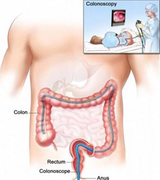 colonoscopia01