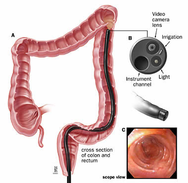 colonoscopia02