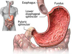 gastritis02