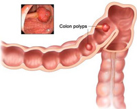 tijuana-gastric-balloon-polipos-colon-min
