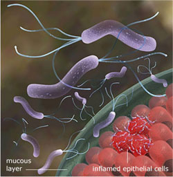 ulcera-peptica02